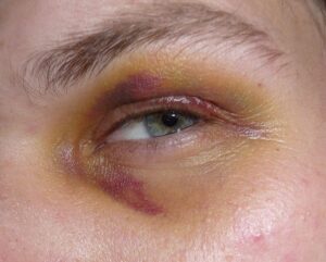 Black eye 